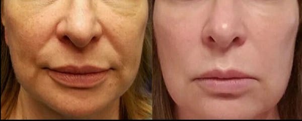 PDO Threads Before & After Gallery - Patient 447319 - Image 1