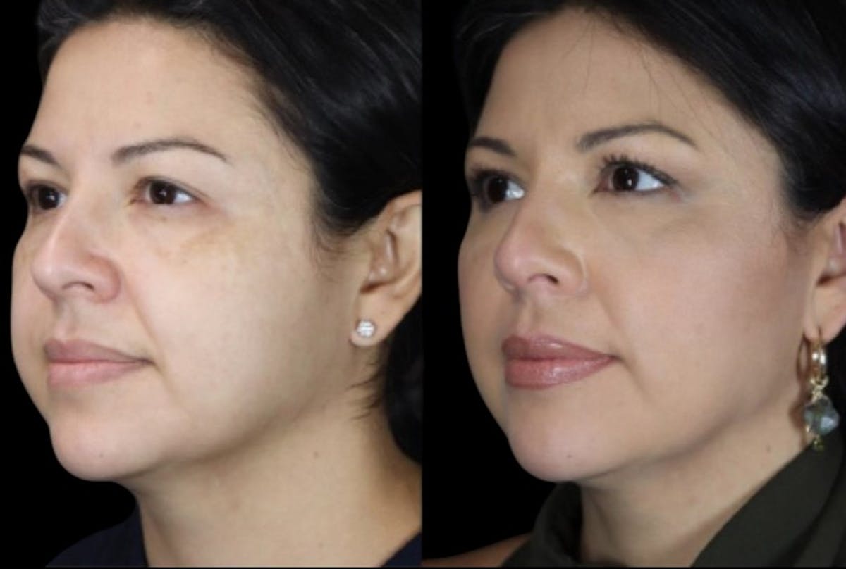 PDO Threads Before & After Gallery - Patient 258814 - Image 1