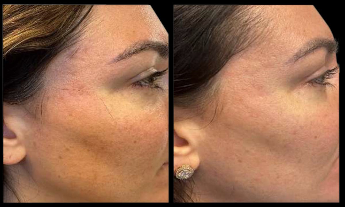 Exosomes Before & After Gallery - Patient 783019 - Image 1
