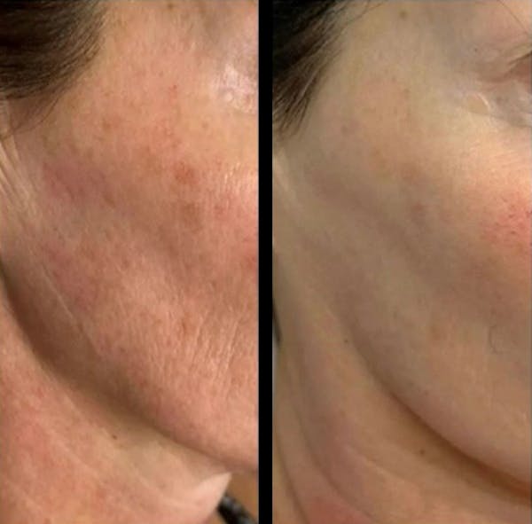 Exosomes Before & After Gallery - Patient 976948 - Image 1
