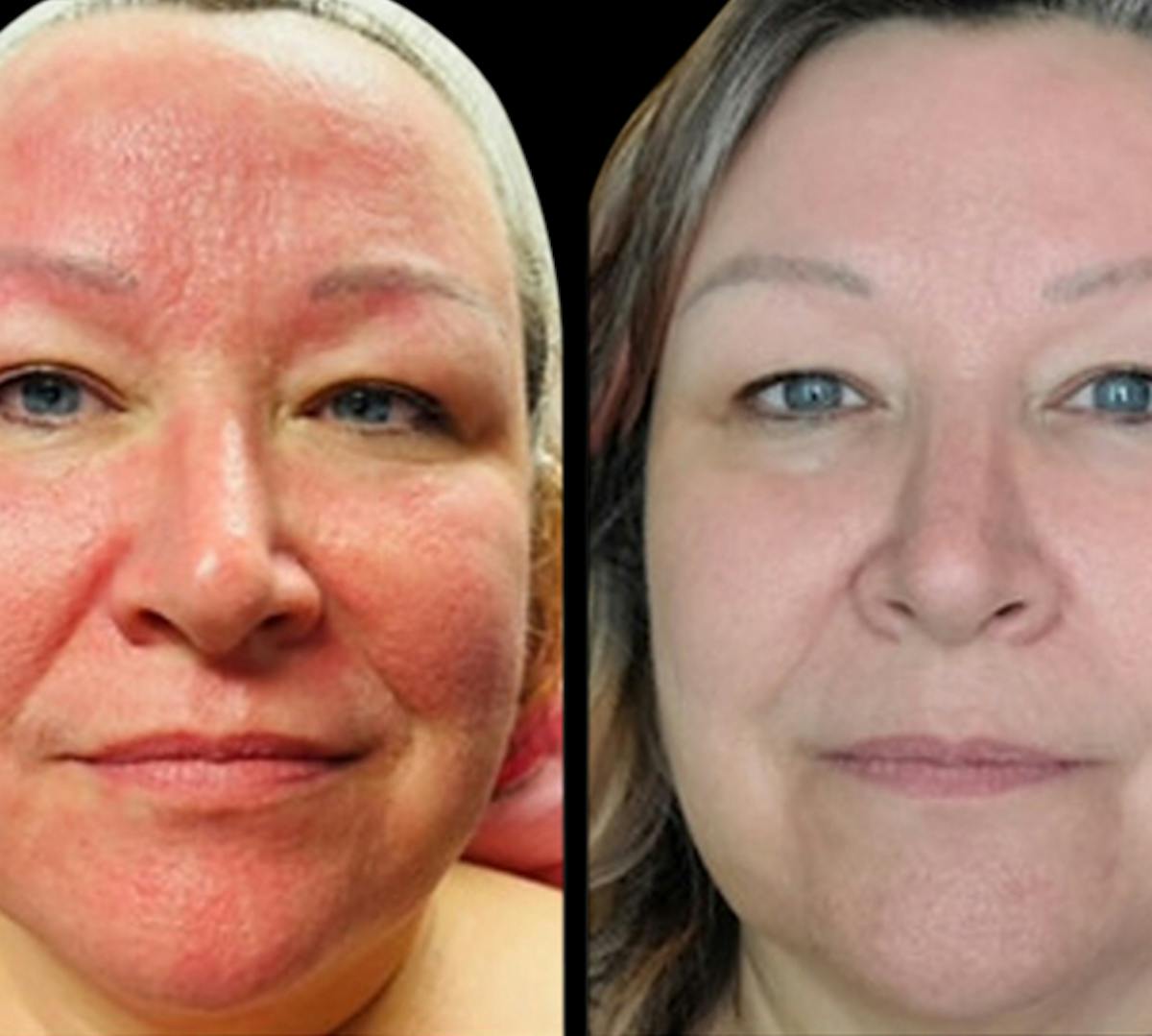 Exosomes Before & After Gallery - Patient 412220 - Image 1