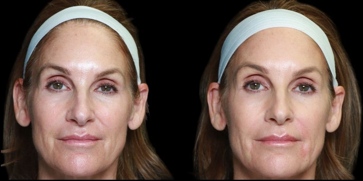 Renuva® Before & After Gallery - Patient 233049 - Image 1