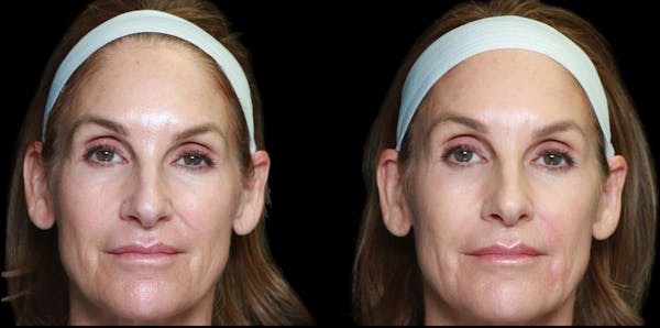 Renuva® Before & After Gallery - Patient 233049 - Image 1