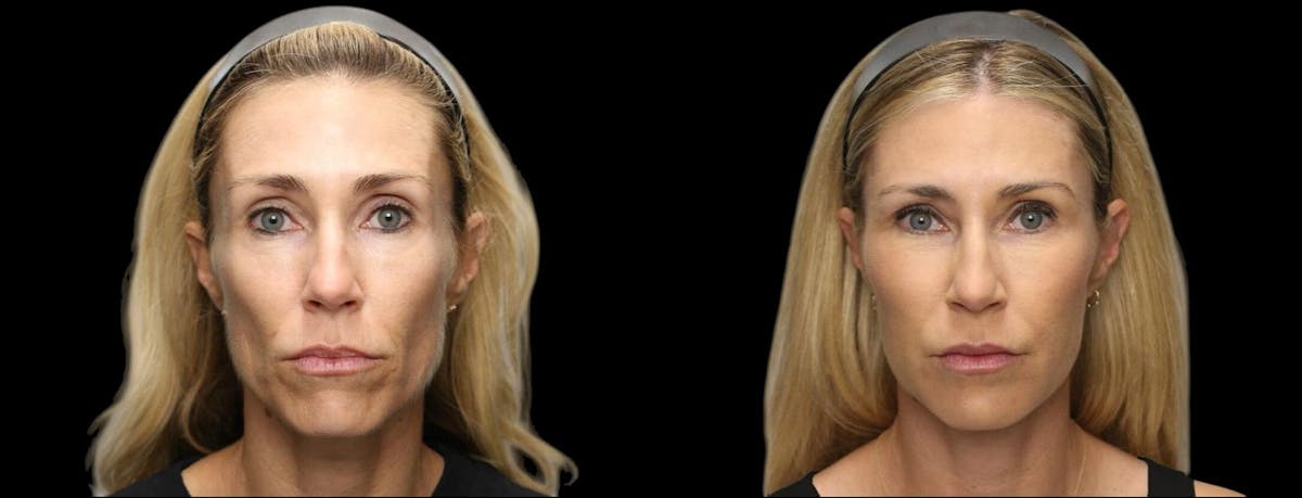 Renuva® Before & After Gallery - Patient 203270 - Image 1