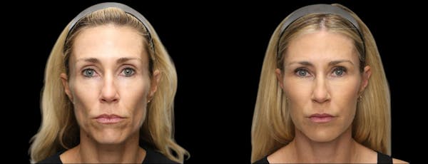Renuva® Before & After Gallery - Patient 203270 - Image 1