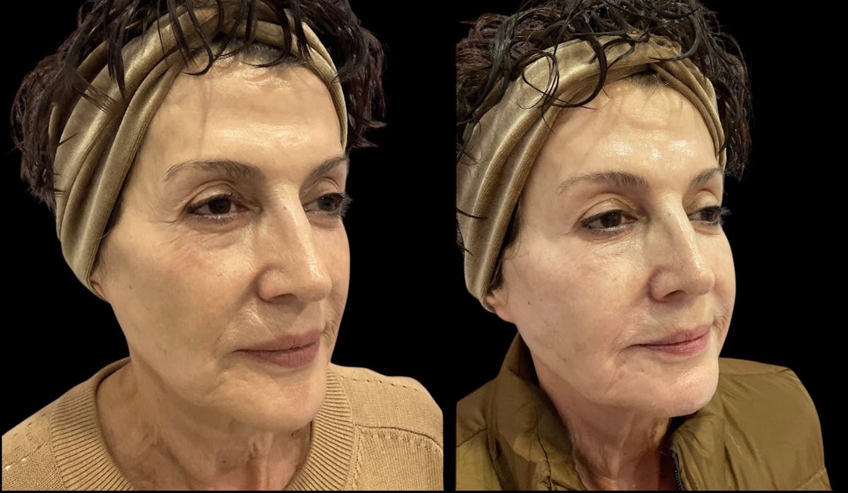 Renuva® Before & After Gallery - Patient 325084 - Image 1