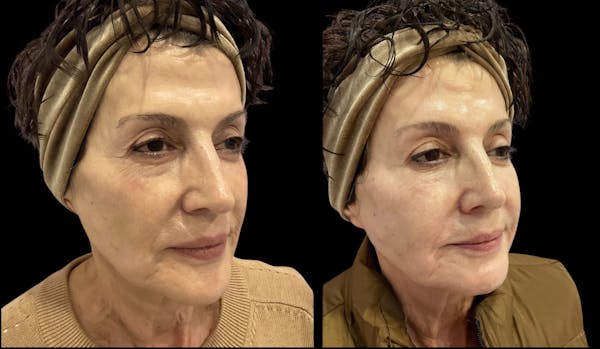 Renuva® Before & After Gallery - Patient 325084 - Image 1