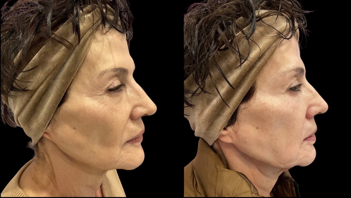 Renuva® Before & After Gallery - Patient 325084 - Image 2