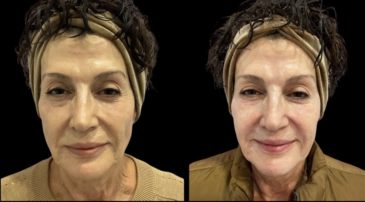 Renuva® Before & After Gallery - Patient 325084 - Image 3