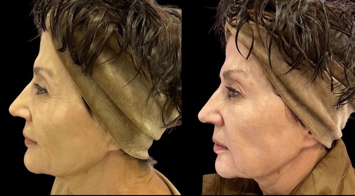 Renuva® Before & After Gallery - Patient 325084 - Image 4