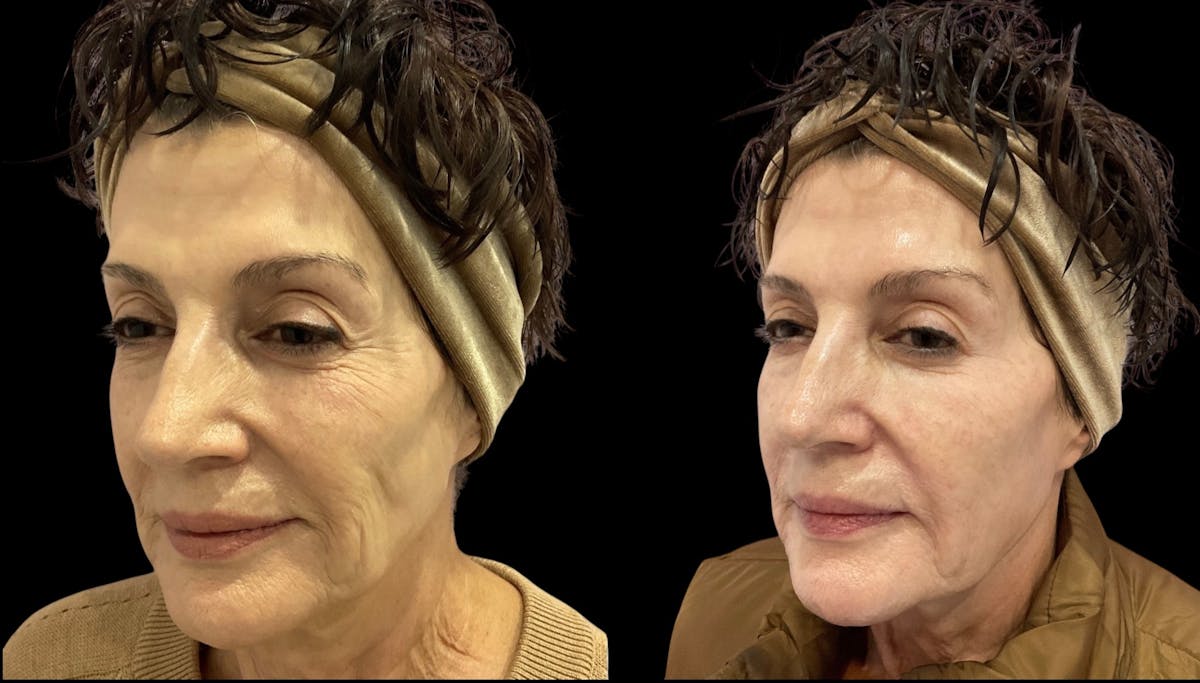 Renuva® Before & After Gallery - Patient 325084 - Image 5