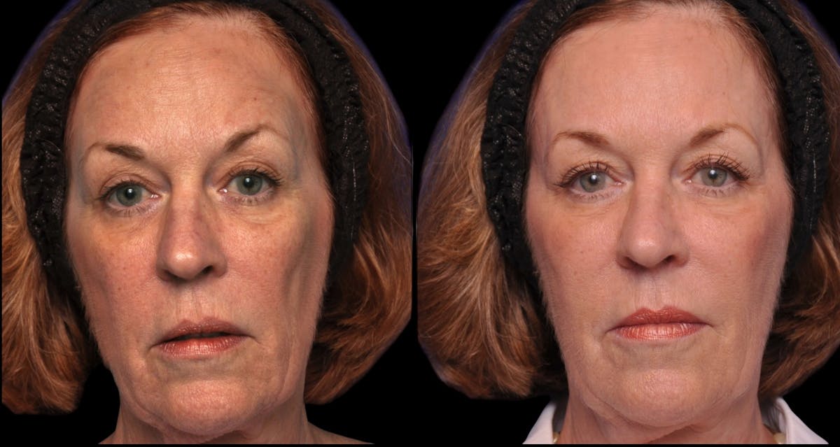 Renuva® Before & After Gallery - Patient 132656 - Image 1