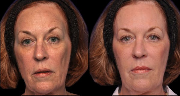 Renuva® Before & After Gallery - Patient 132656 - Image 1