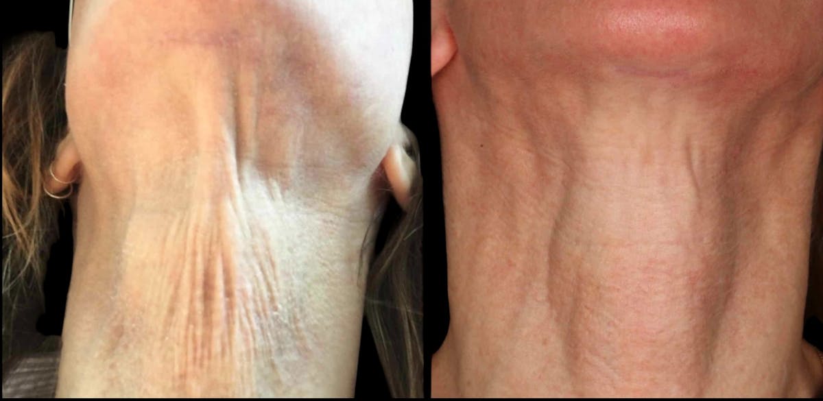 Renuva® Before & After Gallery - Patient 340992 - Image 1