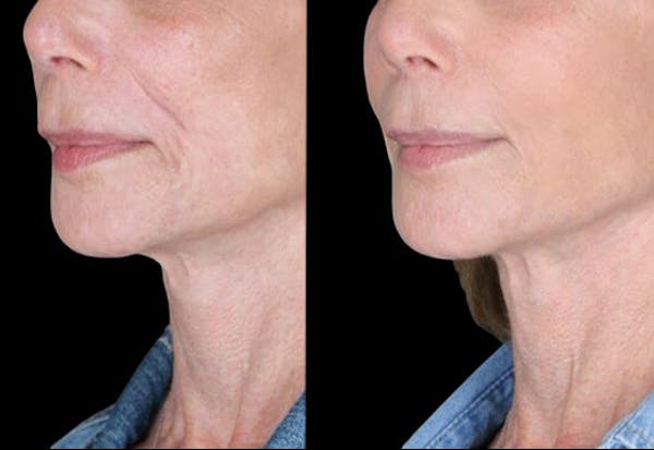Renuva® Before & After Gallery - Patient 958614 - Image 1