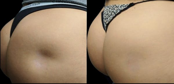 Renuva® Before & After Gallery - Patient 419312 - Image 1