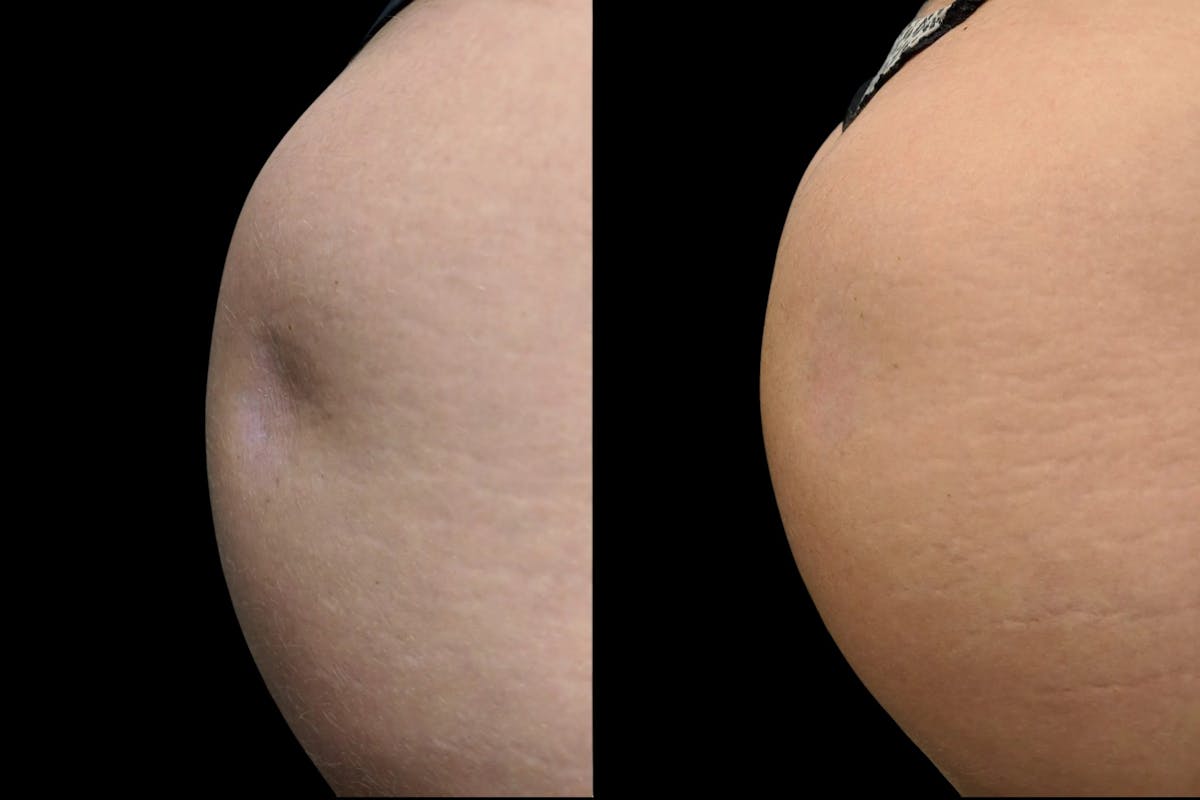 Renuva® Before & After Gallery - Patient 553057 - Image 1