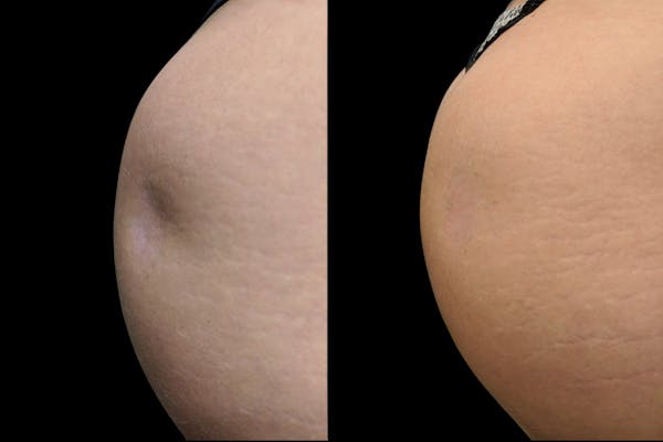 Renuva® Before & After Gallery - Patient 553057 - Image 1