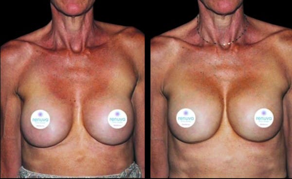 Renuva® Before & After Gallery - Patient 104480 - Image 1