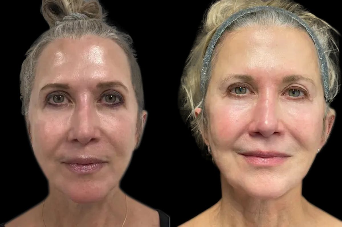 Renuva® Before & After Gallery - Patient 986872 - Image 1