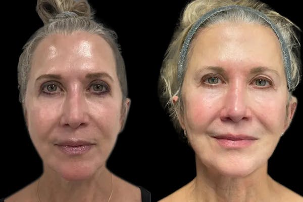 Renuva® Before & After Gallery - Patient 986872 - Image 1