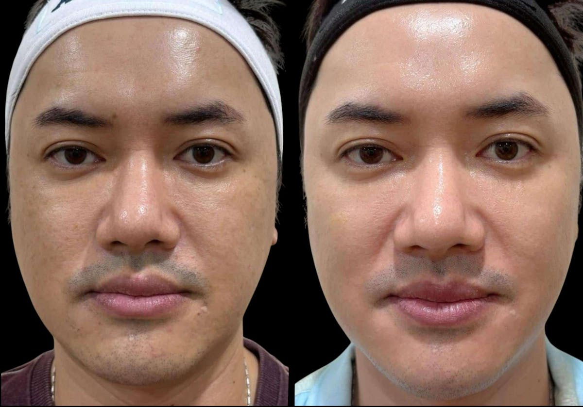 Salmon DNA (PDRN) Before & After Gallery - Patient 158860 - Image 1