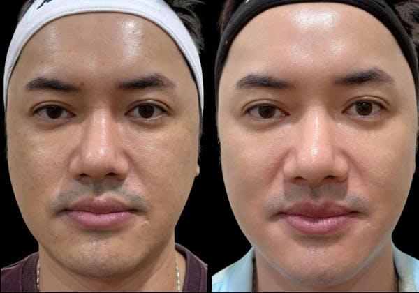 Salmon DNA (PDRN) Before & After Gallery - Patient 158860 - Image 1