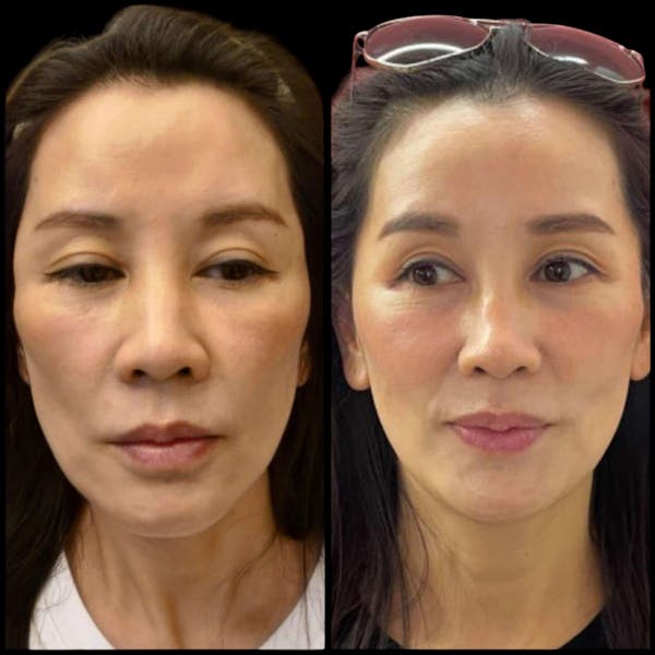 Salmon DNA (PDRN) Before & After Gallery - Patient 345091 - Image 1