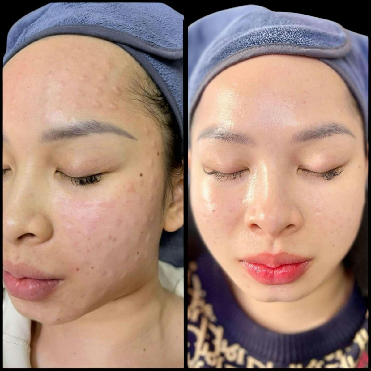 Salmon DNA (PDRN) Before & After Gallery - Patient 379985 - Image 1
