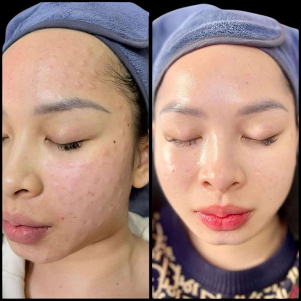 Salmon DNA (PDRN) Before & After Gallery - Patient 379985 - Image 1