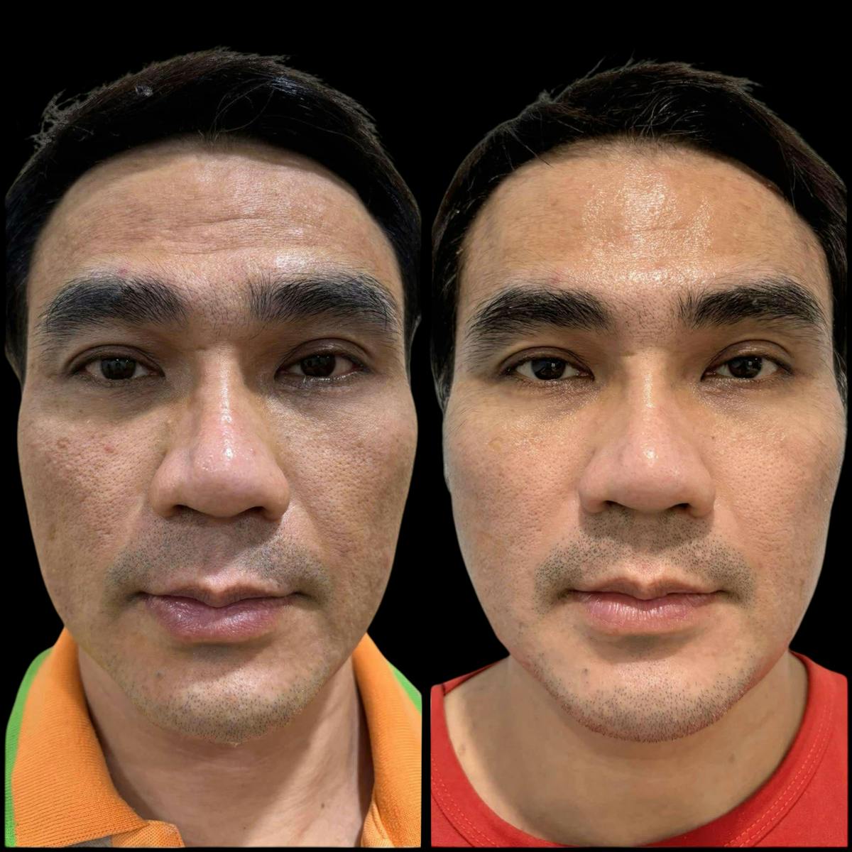 Salmon DNA (PDRN) Before & After Gallery - Patient 280218 - Image 1