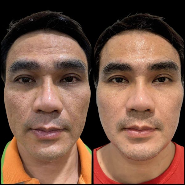 Salmon DNA (PDRN) Before & After Gallery - Patient 280218 - Image 1