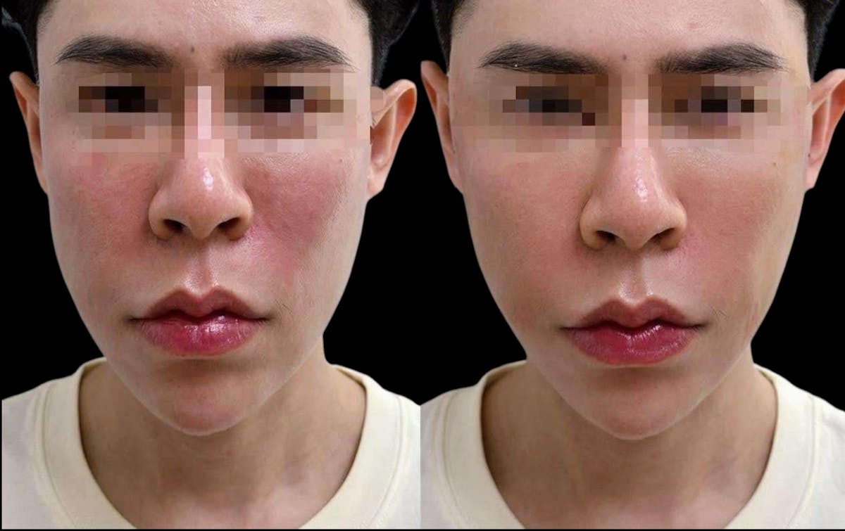 Salmon DNA (PDRN) Before & After Gallery - Patient 144069 - Image 1
