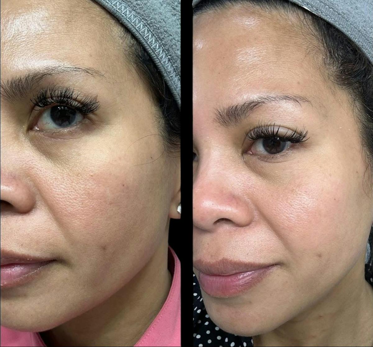 Salmon DNA (PDRN) Before & After Gallery - Patient 241029 - Image 1