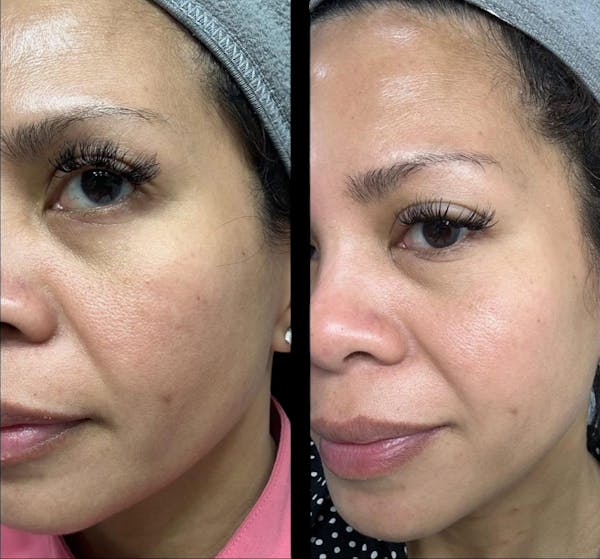 Salmon DNA (PDRN) Before & After Gallery - Patient 241029 - Image 1