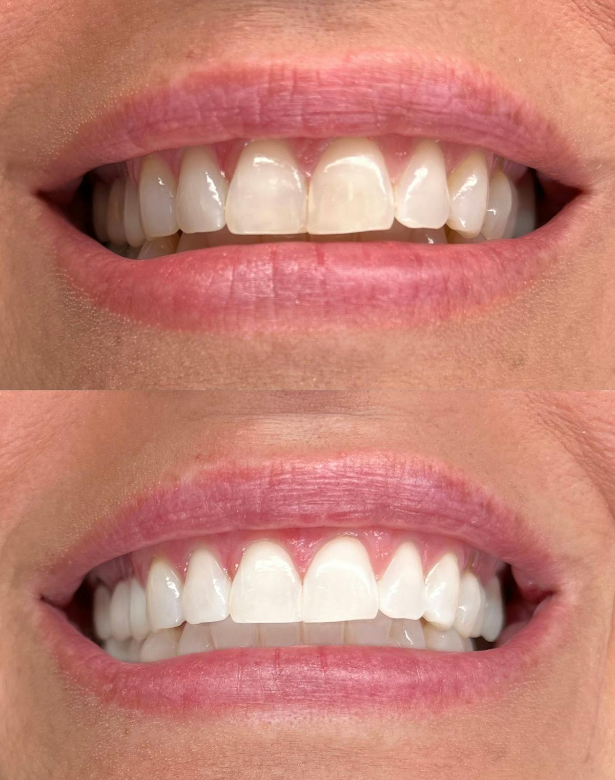 Teeth Whitening Before & After Gallery - Patient 140002 - Image 1