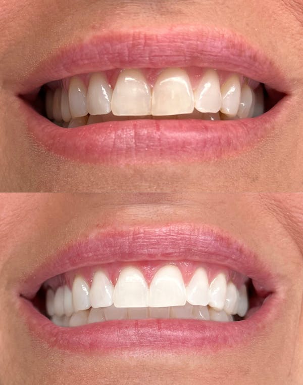 Teeth Whitening Before & After Gallery - Patient 140002 - Image 1