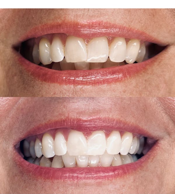 Teeth Whitening Before & After Gallery - Patient 347872 - Image 1