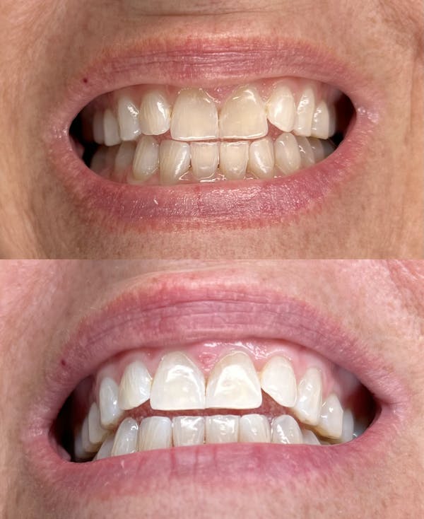 Teeth Whitening Before & After Gallery - Patient 350005 - Image 1