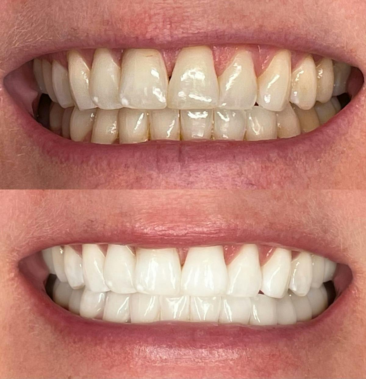 Teeth Whitening Before & After Gallery - Patient 185820 - Image 1
