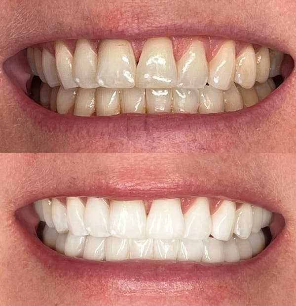 Teeth Whitening Before & After Gallery - Patient 185820 - Image 1