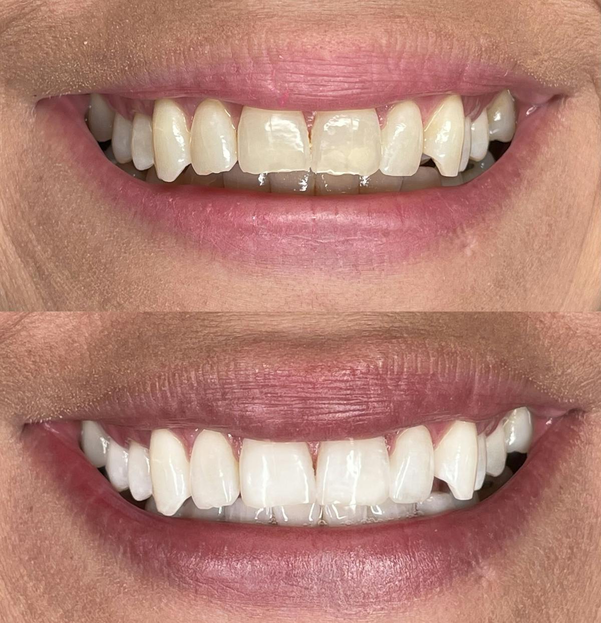 Teeth Whitening Before & After Gallery - Patient 391583 - Image 1
