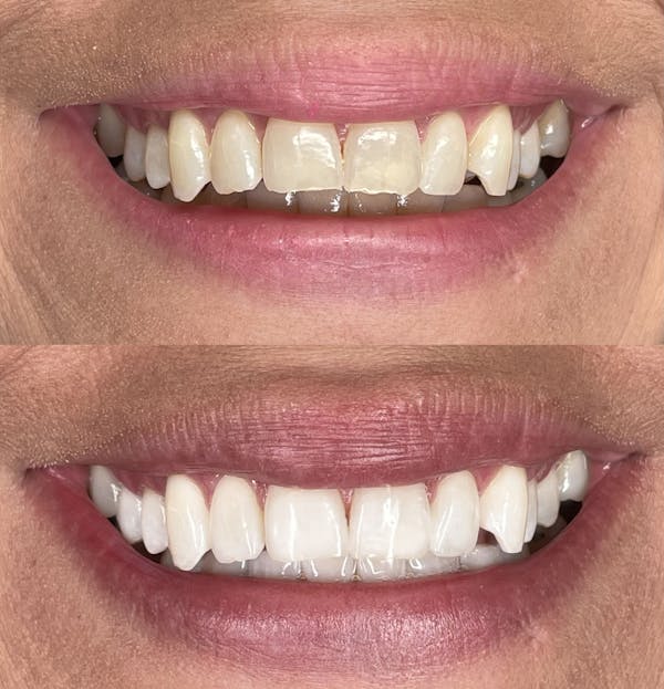 Teeth Whitening Before & After Gallery - Patient 391583 - Image 1