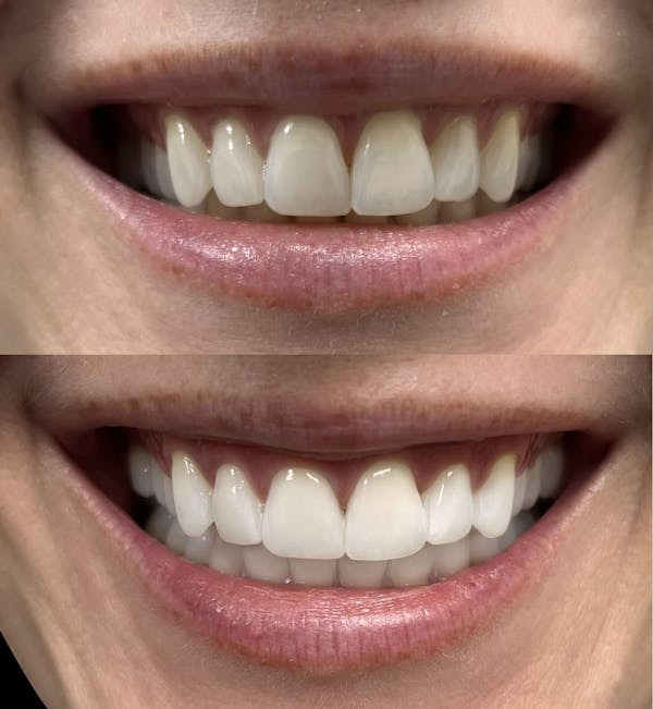 Teeth Whitening Before & After Gallery - Patient 708558 - Image 1