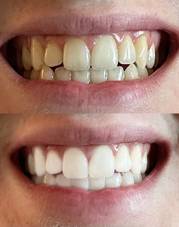 Teeth Whitening Before & After Gallery - Patient 237212 - Image 1