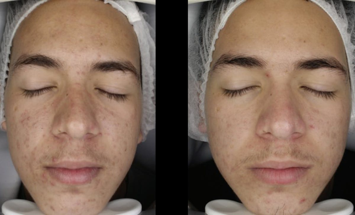 Toskani (Peptides) Before & After Gallery - Patient 188920 - Image 1