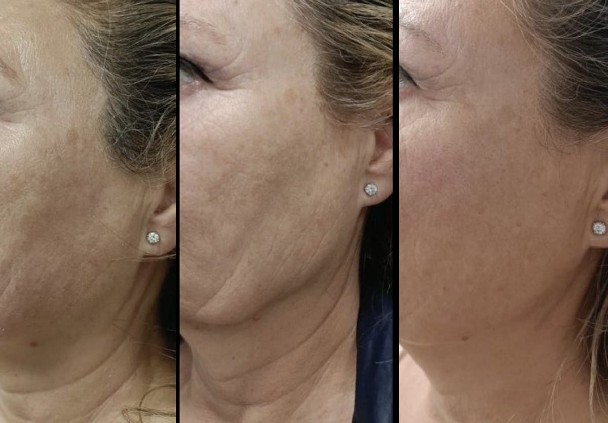 Toskani (Peptides) Before & After Gallery - Patient 286563 - Image 1