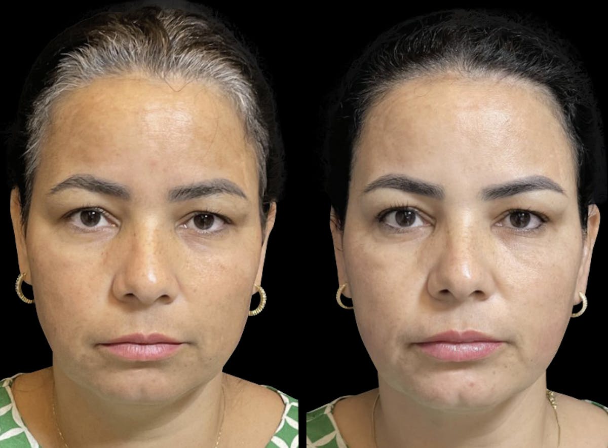 Toskani (Peptides) Before & After Gallery - Patient 157153 - Image 1