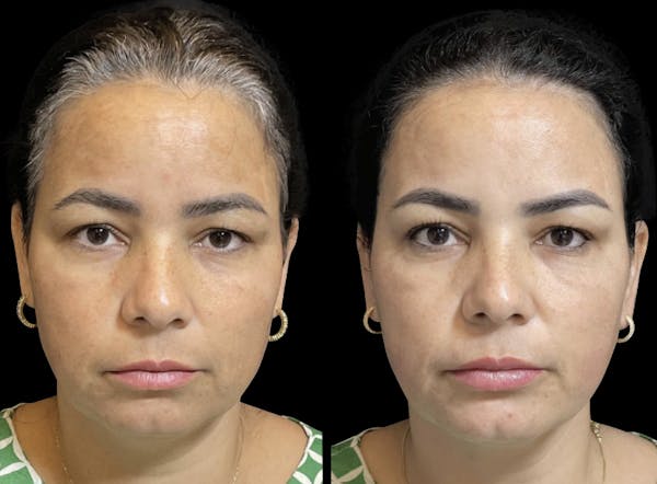 Toskani (Peptides) Before & After Gallery - Patient 157153 - Image 1