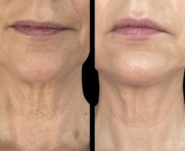 Toskani (Peptides) Before & After Gallery - Patient 315682 - Image 1